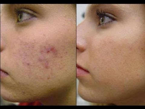 قناع الأسبرين للتخلص نهائياً من البثور وحب الشباب