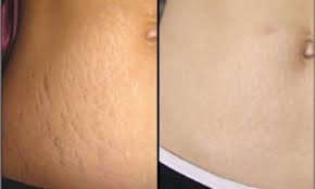 6 وصفات للتخلص من تشققات الحمل وعلاجها