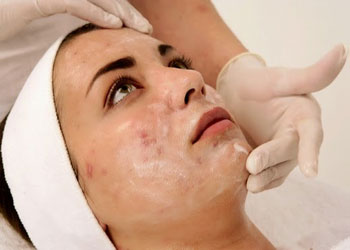 ماسك الأسبرين لعلاج حب الشباب