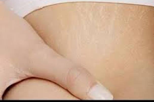 تخلصي من ترهل جلدكِ بعد الولادة