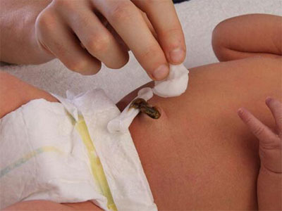 طرق للتعامل الجيد مع الحبل السري