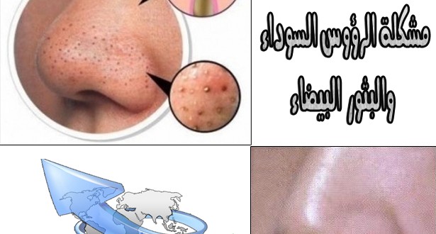 اسهل الطرق لعلاج الرؤوس السوداء