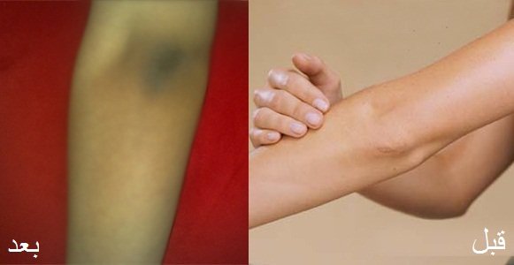طريقة تبييض "الكوعين " بأبسط المكونات