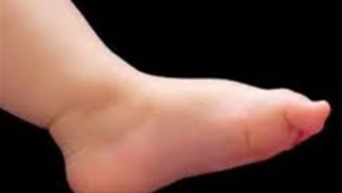 3 نصائح للتعامل مع الطفل المصاب بالفلات فوت