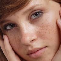 خلطات طبيعية لإزالة كلف الحمل