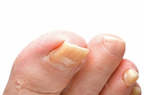 علاج إلتهابات الأظافر