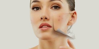أخطاء يومية تسبب تفاقم مشكلة حب الشباب