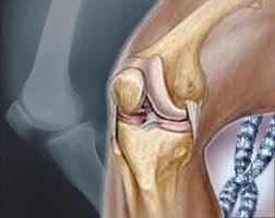 تعرف على أفضل طرق علاج هشاشة العظام