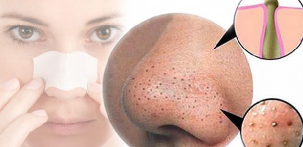 بعض الطرق المنزلية للتخلص من الرؤوس السوداء