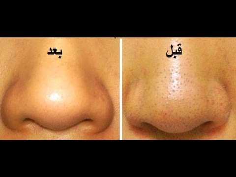 طرق طبيعية لإزالة الرؤوس السوداء