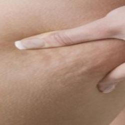 9 أطعمة لمحاربة السيلوليت