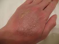 طرق للتخلص من آثار الحروق