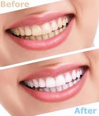 طريقه سهله لتبييض الاسنان
