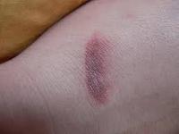 طرق طبيعية لتتخلصي من آثار الجروح  