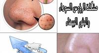 اسهل الطرق لعلاج الرؤوس السوداء