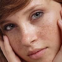 خلطات طبيعية لإزالة كلف الحمل 