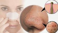 إليك 16 حلاً سريعاً للتخلص من مشكلة البثور