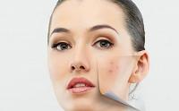 خلطات للتخلص من حب الشباب
