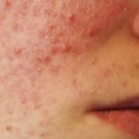 أسباب ظهور بقع حمراء على الجسم .