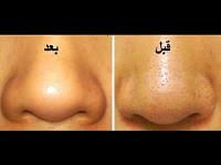  طرق طبيعية لإزالة الرؤوس السوداء
