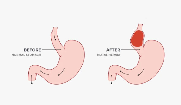 علاج فتق الحجاب الحاجز بالأعشاب